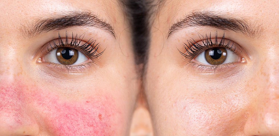 Rosacea verstehen: Ursachen, Symptome und wirksame Behandlung